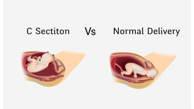 Can I Have a Vaginal Birth If I Had a Previous C-Section?